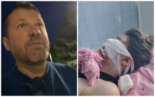  Краснодарский хирург Алексей Дикарев прокомментировал лечение 15-летней девочки из Темрюка, которой собака откусила лицо